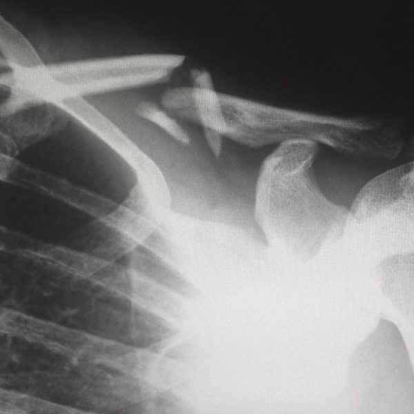 röntgenfoto bij artikel over letselschade en pre-existente klachten en alternatieve oorzaken